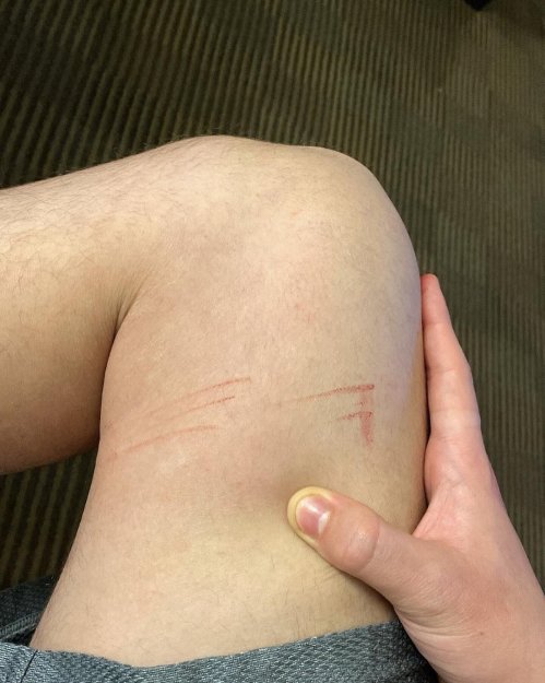 A close-up of a knee with red scratch marks, while a hand gently holds the leg.