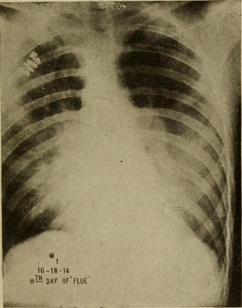 X-ray image of a chest showing rib outlines and lung structure, dated October 18, 1914, labeled "5th day of 'Flu'."