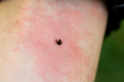 A close-up of a tick on a person's skin, surrounded by a red rash.