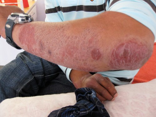 A close-up of a person's arm showing red, scaly patches and dry skin, indicating a skin condition.