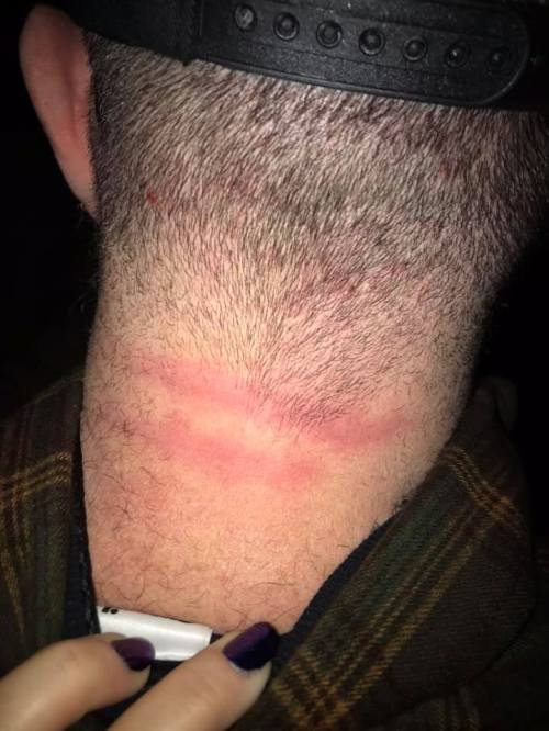 Close-up of a person's neck showing a red, irritated line, possibly from a tight collar or strap.