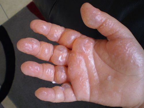 A close-up of a hand with wrinkled, pruney skin, suggesting prolonged exposure to water.