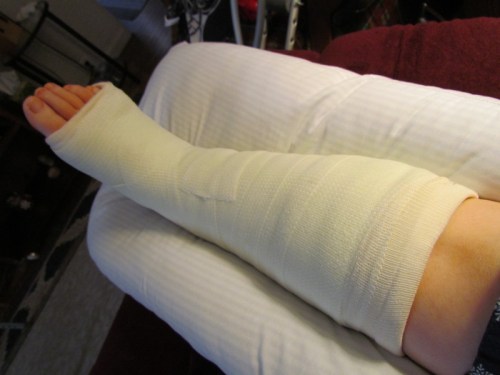 A leg in a white cast resting on a couch, with a foot visible at the end of the cast.