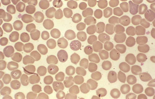 Microscopic view of red blood cells, showing various shapes and sizes in a light-stained background.