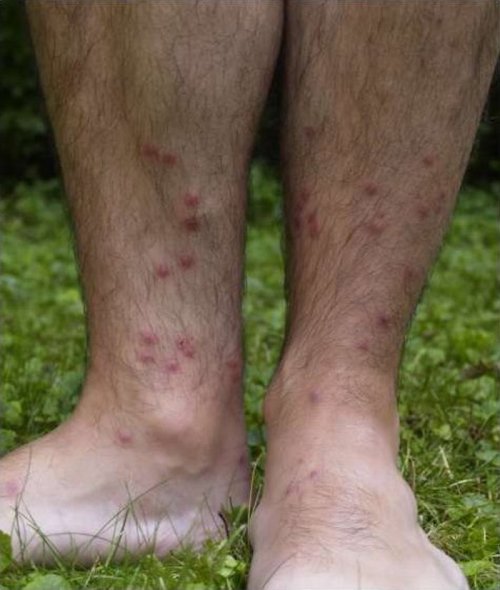 Close-up of legs with red, raised bumps on the skin, surrounded by green grass.
