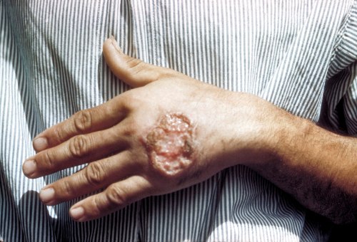 A close-up of a hand showing a large, inflamed wound on the wrist with a reddish, raised surface.