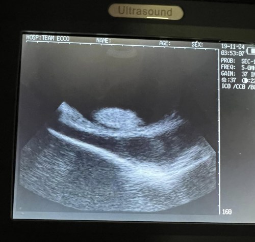 Ultrasound image showing a grayscale view of internal structures, likely related to a medical examination.