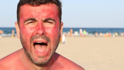 A man with sunburned skin screams in frustration on a beach, with people and the ocean in the background.